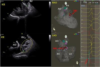 Electrocardiographic criteria for localization of ventricular premature complexes from the inferior right ventricular outflow tract